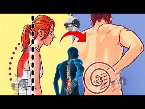 Video: A mund të shkaktojë dhimbje shpine kanceri rektal?