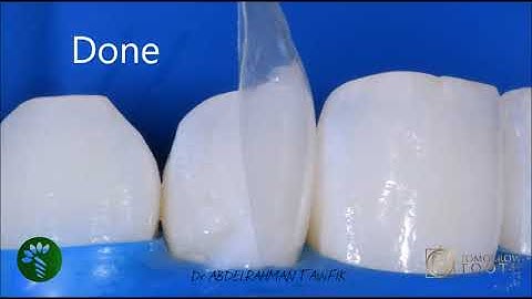 black triangle closure in 30 minutes using Bioclear Matrix