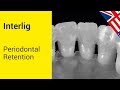 INTERLIG - Periodontal Retention