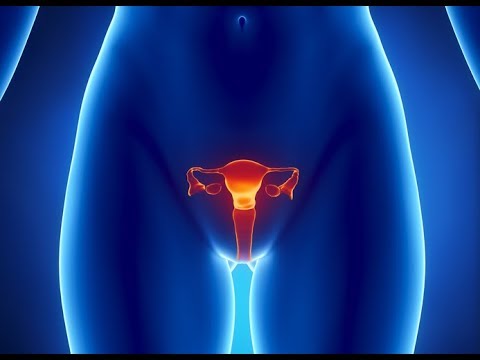 Video: ¿Qué significa endocervicitis?
