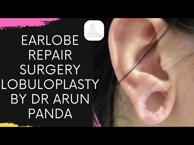 Best Ear Lobe Repair Specialist in Mumbai