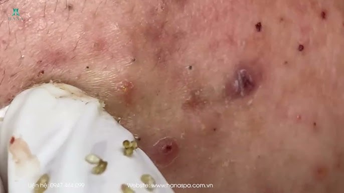 Big Cystic Acne Blackheads Extraction Blackheads & Milia, Whiteheads  Removal Pimple Popping - YouTube