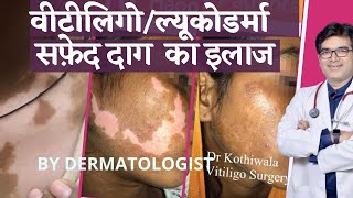 Vitiligo/ Leucoderma Treatment In Hindi (सफ़ेद दाग़ कारण, इलाज | Dermatologist | Dr. Sunil Kothiwala