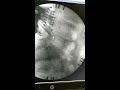 Lumbar spine surgery l3 to l5