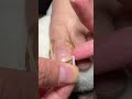 Toe Nail Fixer| Ingrown Toenail Cleaning & Care #ToenailFix #NailCare #FootCare #PedicureClean