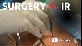 General Surgery vs Interventional Radiology