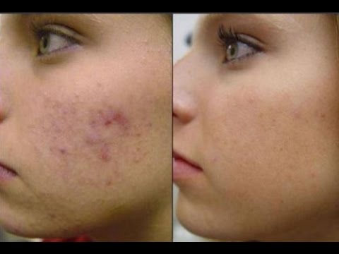 Acne scar removal at home |  ways to use avocado seed for beautiful skin