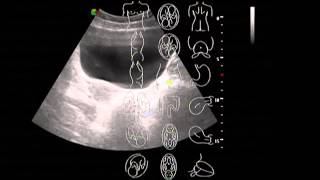 5  Ультразвуковая анатомия органов малого таза у женщин видеолекция на УЗ сканере