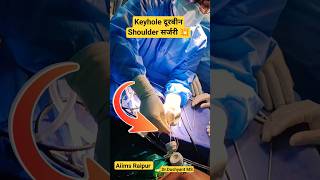 Key Hole Shoulder Surgery 🔥 छोटे छेद से कंधे का ऑप्रेशन 💥#shoulder#shoulderdislocation #shoulderpain