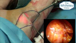 World's First ELSA - Endoscopic Laser Sweat Ablation - cure underarm sweating