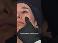 Live Tear Trough Filler: Treating Under the Muscle 💎 GEM©️ by Harley Academy Filler Case Study