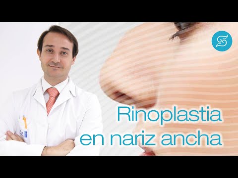 Rinoplastia en nariz ancha ¿cómo es la cirugía de nariz si es ancha?