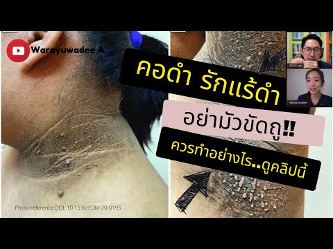 หลังคอดำต้องทำอย่างไร Acanthosis nigricans | Feb 21, 2022