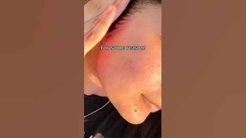 Treat Your Acne Marks | Deconstruct Clearing Serum #shorts #shortsyoutube #acnemarks