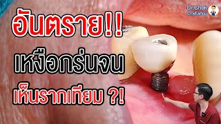 เหงือกร่น จนเห็นรากฟันเทียม อันตรายไหม พี่หมอแก้อย่างไร ?!! l คลายปัญหารากฟันเทียมกับหมอโชค