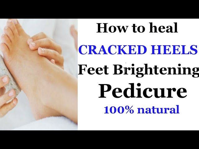 5,000+ Cracked Heel Stock Photos, Pictures & Royalty-Free Images - iStock |  Dry skin, Ingrown toenail, Halitosis