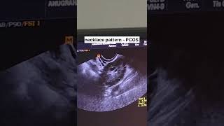 PCOS- "The String of pearls" #doctor #hospital #health #love