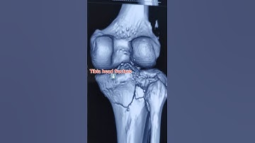 C.T Knee 3d reconstructed image  #fracture #ctscan #ncct