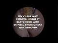Sticky ear wax removal using St Barts Hook with detailed shots of wax removed - Ep 14