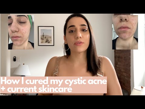 HOW I GOT RID OF MY CYSTIC ACNE & ACNE SCARS (REAL RESULTS)