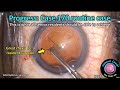 Cataractcoach 2172 progress case 170 routine case