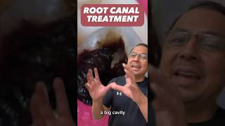 How Much is a Root Canal? EXPENSIVE | View Mobile Dental #shorts
