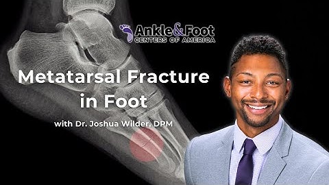 Metatarsal Fracture In Foot | Ankle & Foot Centers of America