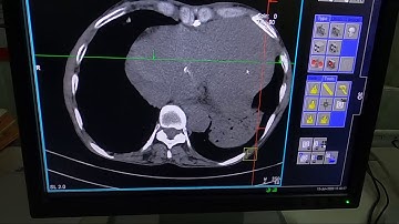 INTERVENTION- How to do a CT guided Lung Biopsy? Steps and techniques.