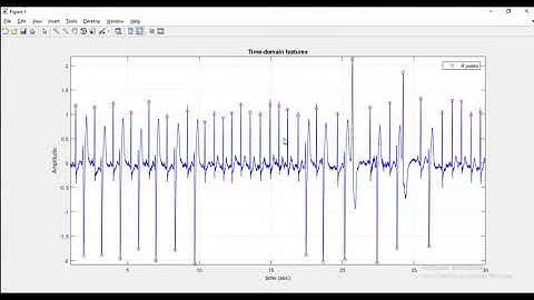 Detection of cardiac arrhythmia through HRV Matlab Projects