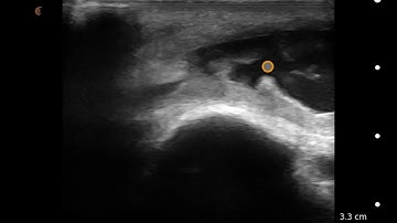 Image Interpretation: Olecranon Bursitis
