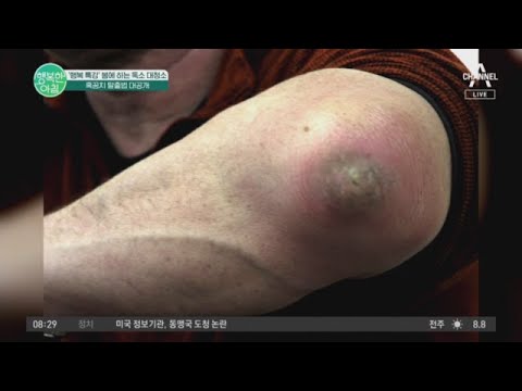 다가오는 여름! 흑꿈치(팔꿈치가 검은)를 피해라 | 행복한 아침 11077 회