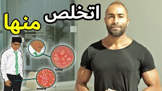 أفضل وصفة طبيعية للقضاء على القرح الباردة - الهربس | بدون أدوية | HERPES - COLD SORES