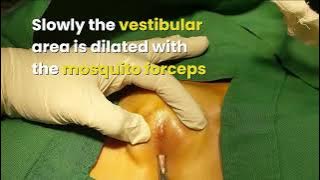 What is a Hymen and How Does It break | Dr. Ashutosh Shah | Elegance Clinic - Surat