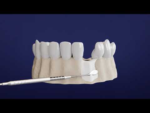 Step by Step Guide to Your Dental Implant Procedure - Spanish Translation - video from EthOss Regeneration