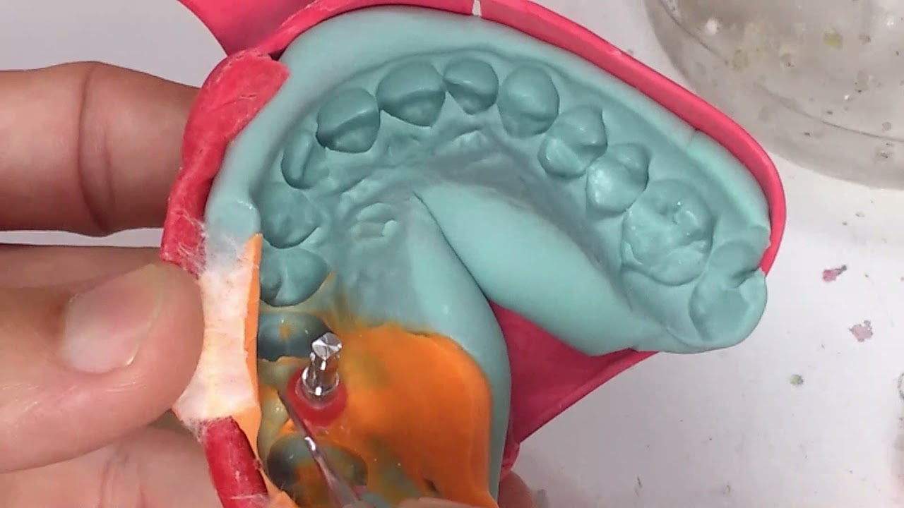 Coping sobre implante, fundição do ucla com cinta metálica e o perfil cervical.