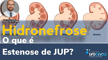 O que pode ocorrer com a estenose de JUP?