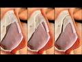 5 rhinoplasty techniques ⭕️ KAMINSKYI