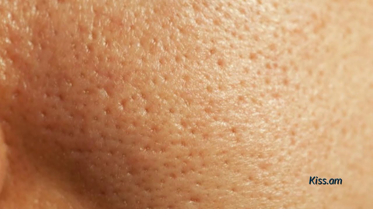 Մաշկի ծակոտիները զգալի չափով կանհետանան այս 4 միջոցներով