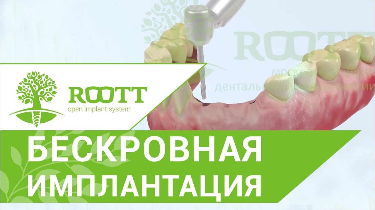 Имплантация зубов без разреза десны. 🎻 Этапы имплантации зубов без разреза десны. ROOTT.