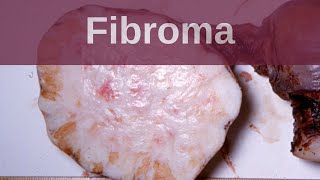 Ovarian Fibroma - Pathology mini tutorial