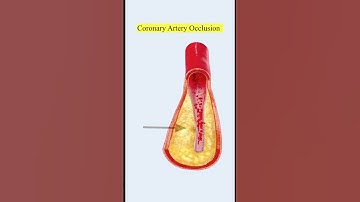 Myocardial Infarction (MI) Heart Attack | #shorts #viral #medical #study