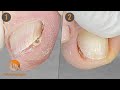 Onychophosis : the annoying callus in the groove | I remove it for immediate relief || 2 cases