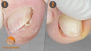 Onychophosis : the annoying callus in the groove | I remove it for immediate relief || 2 cases