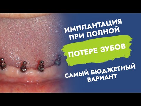 Имплантация при полной потере зубов. Самый бюджетный вариант.