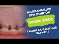 Имплантация при полной потере зубов. Самый бюджетный вариант.