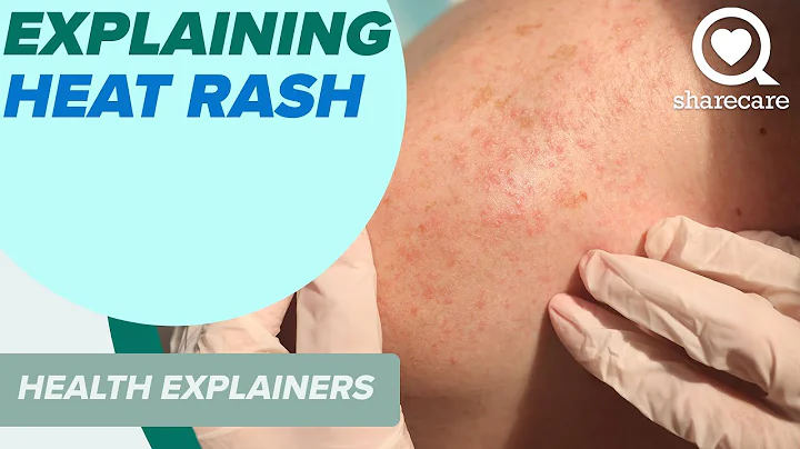 Explaining Heat Rash And How To Treat It | Health Explainers | Sharecare - DayDayNews