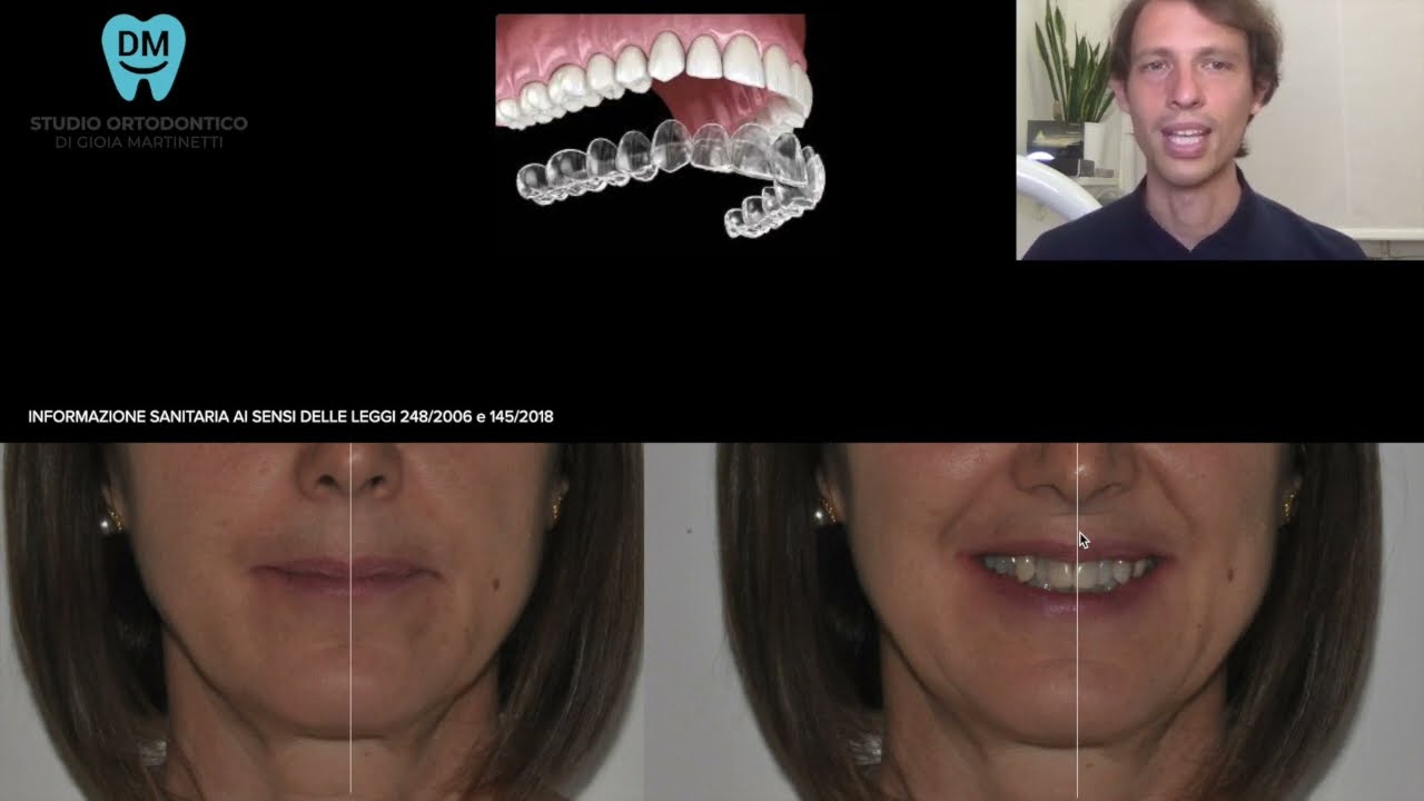 PRIMA DOPO apparecchio per sorriso in adulto affollamento allineatori trasparenti quasi invisibili