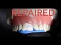 How the dentist repairs a chipped tooth