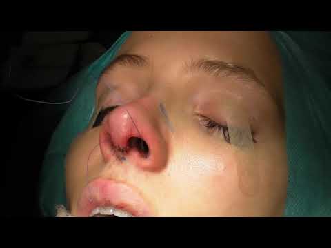 Video: Rhinoplasty: Årsaker, Prosedyre Og Utvinning