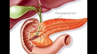 ★ Как избавиться от  панкреатита в домашних условиях. 3 золотых принципа лечения панкреатита. Рацион